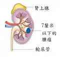 階段1的腎癌