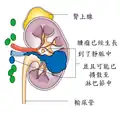 階段3的腎癌