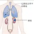 階段4的腎癌